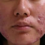 ACNE VULGARIS (PIMPLES): Yes, it Could be Embarrassing!!!