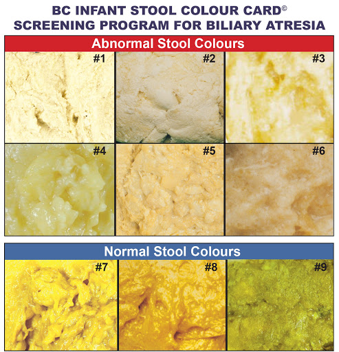 stool color chart graces for baby meg diagnostico de la atresia de