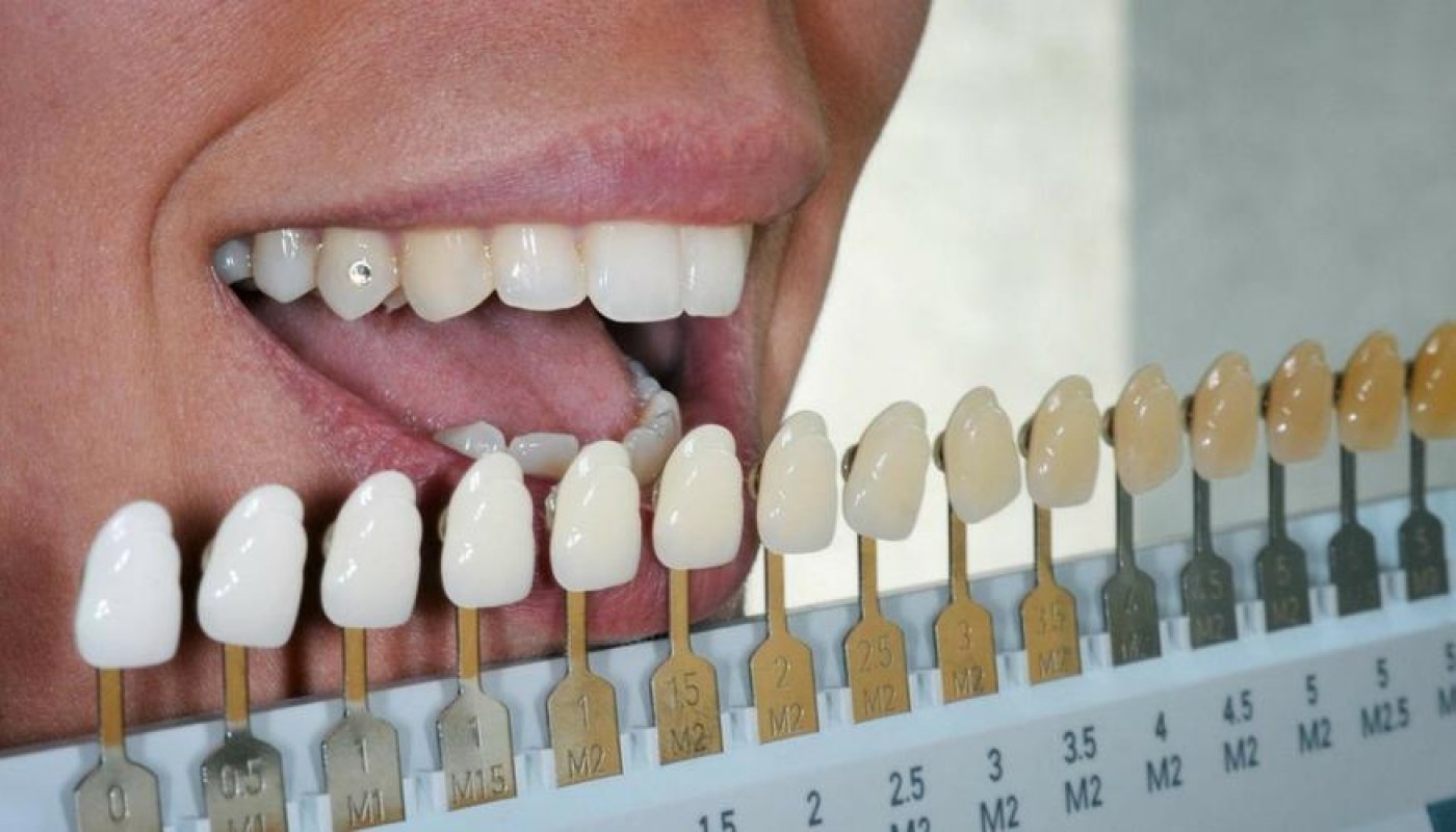 WHAT DOES THE COLOUR OF YOUR TEETH HAVE TO SAY ABOUT YOU