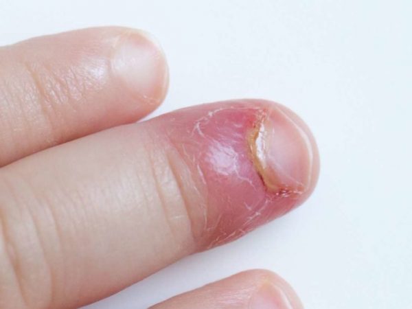 Redness of the nail bed caused by infection - wide 7