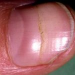 WHAT ARE YOUR FINGERNAILS SAYING ABOUT YOUR HEALTH?