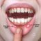 MOUTH ULCERS (CANKER SORES)