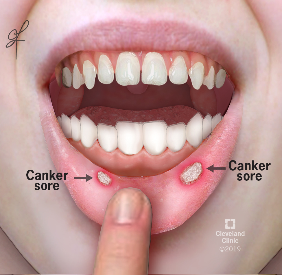 MOUTH ULCERS (CANKER SORES) | HealthGist.Net